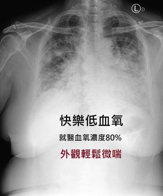 ▲檢疫所待2天！60歲確診婦「無明顯不適」　醫驚覺不妙...急幫插管。（圖／翻攝自臉書／蘇一峰）