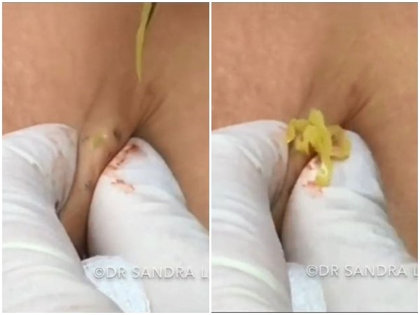 ▲▼皮膚科醫師一擠她腋下「爆出超噁黃膿」。（圖／翻攝自TikTok／@drpimplepopper）