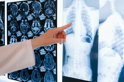 30歲女師健檢發現肺結節！放著不管一年「變肺腺癌末期」