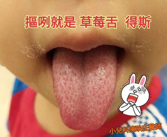 ▲▼醫師提醒，若孩子出現發燒 + 草莓舌的情況，一定要盡速就醫。（圖／醫師陳映庄提供）