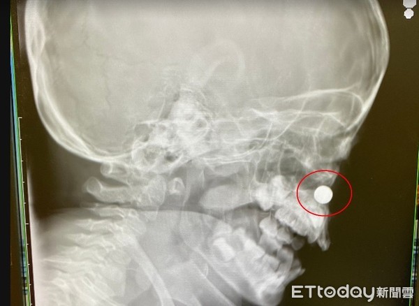 ▲2歲男童鼻子莫名流黃膿，X光一照赫見「超危害鼻腔異物」。（圖／院方提供）