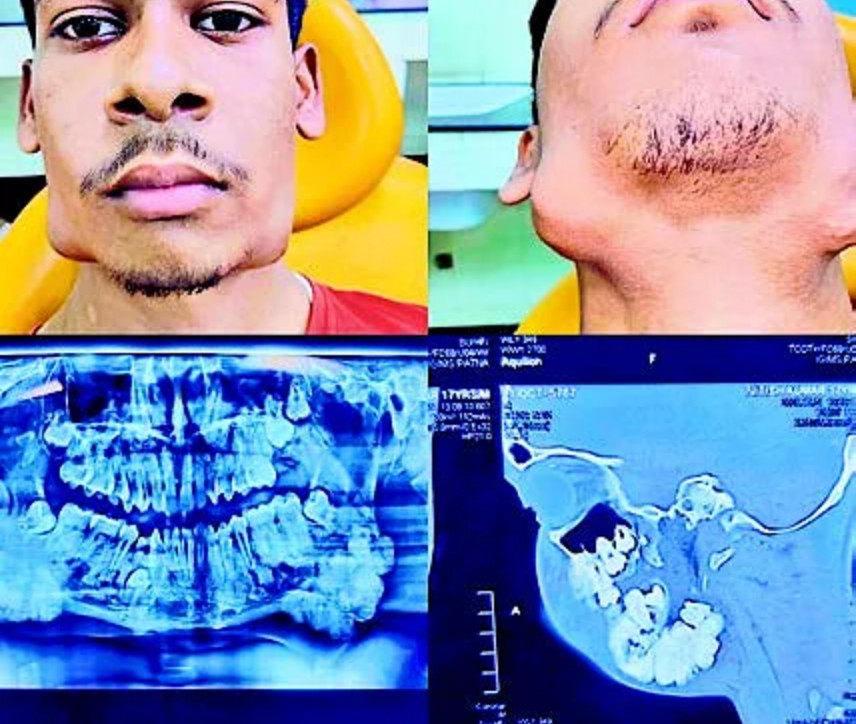 ▲▼印度17歲少年庫馬爾（Nitish Kumar）長了82顆牙齒。（圖／翻攝自推特）