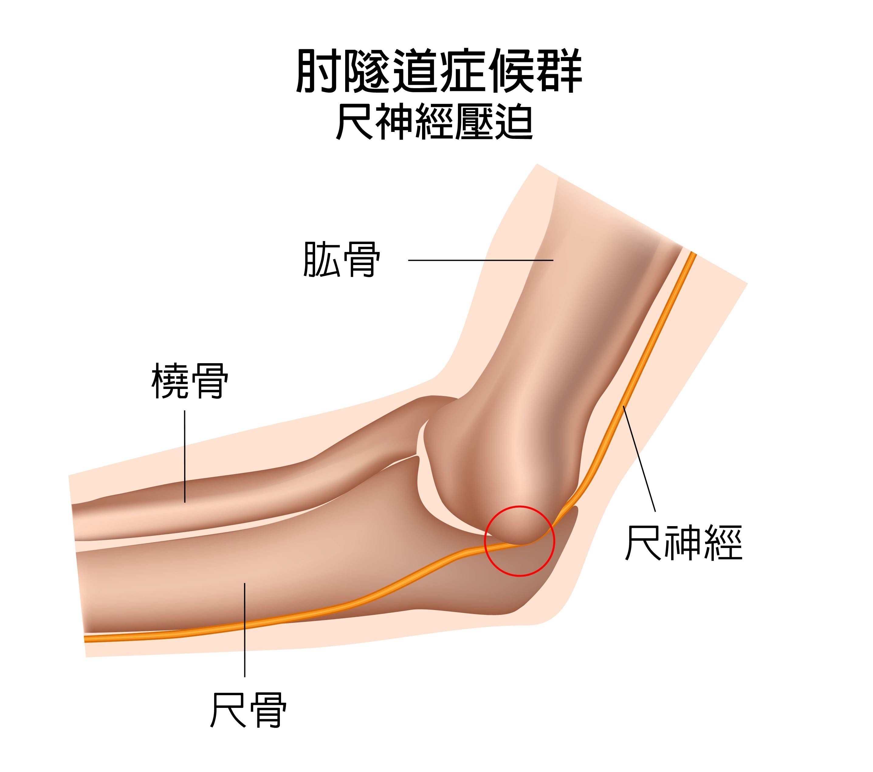 ▲▼肘隧道症候群。（圖／中國醫藥大學新竹附設醫提供）