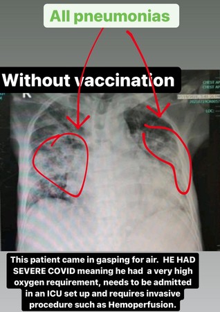 ▲▼菲國醫生秀出X光照，顯示疫苗可有效保護肺部免纖維化。（圖／翻攝自Facebook／Dr. Anne Gabriel-Chan）