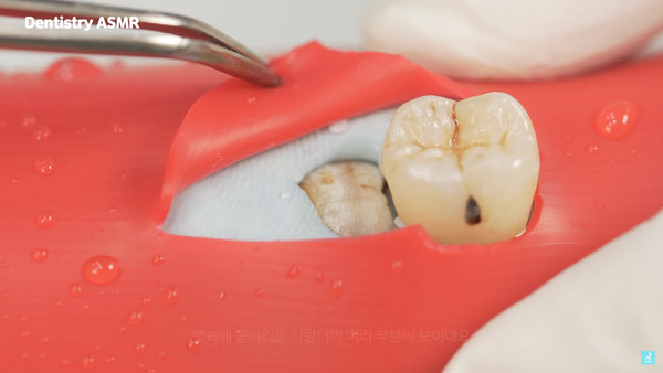 ▲▼牙醫師為患者打麻醉、消毒後，會劃開患者的牙齦，找出隱藏的智齒。（圖／翻攝自Youtube）