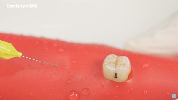 ▲▼牙醫師為患者打麻醉、消毒後，會劃開患者的牙齦，找出隱藏的智齒。（圖／翻攝自Youtube）