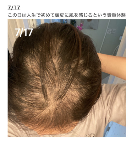 7月17日，頭髮已掉了一大半。（翻攝ameblo.jp網站）