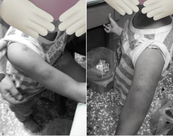 ▲6歲男童慘被母親同居人虐打，手臂大片瘀青讓人心疼。（圖／翻攝自臉書／爆怨2公社）
