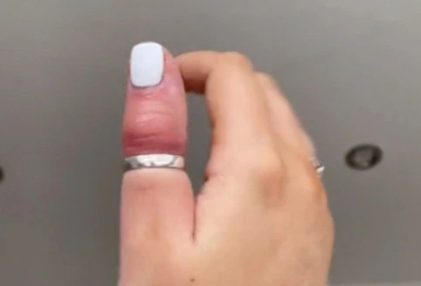 女網紅戴戒指睡覺悲劇！　影片曝醒來「拇指腫脹發紫」險壞死 | ETtod
