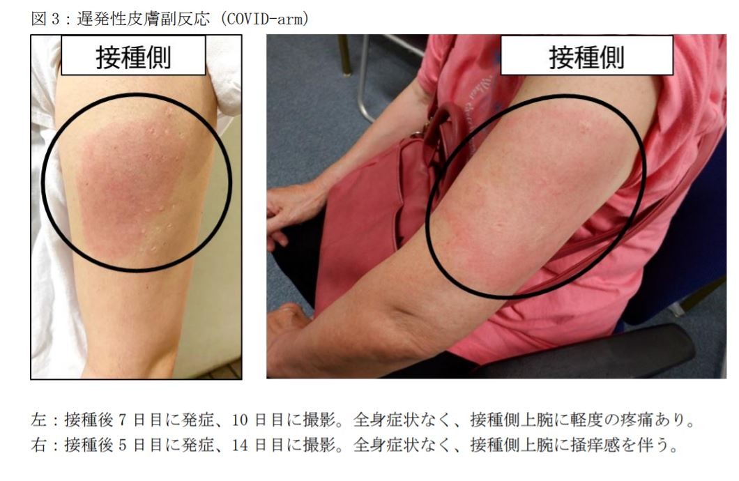 ▲▼ 日本公布「莫德納手臂」！每18人就有1人出現副作用　83%是女性。（圖／取自厚生勞動省調查報告）
