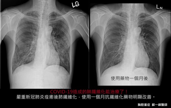 染疫後「肺纖維化」自然痊癒？中國研究：這一族群變更嚴重。（圖／截自蘇一峰粉專）