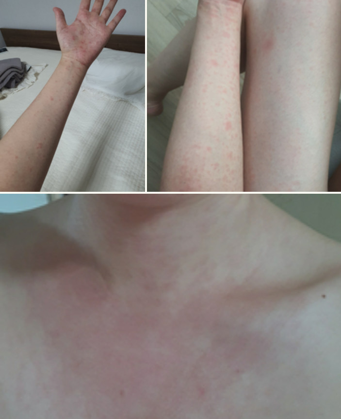 ▲▼南韓女網友痛訴，打完第2劑輝瑞疫苗後手部出現紅斑。（圖／翻攝自Naver Blog）