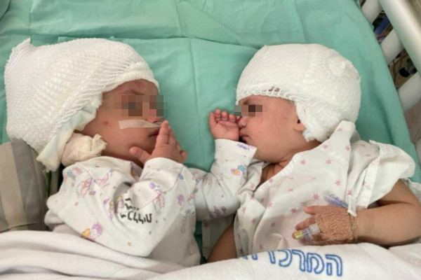 ▲▼ 以色列首例，連頭雙胞胎經過12小時手術分離成功。（圖／翻攝自Facebook）