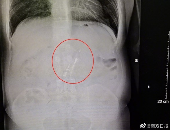 ▲▼男喝醉酒「吞下打火機」　3天後胃鏡取出「竟還能點火！」。（圖／翻攝微博）