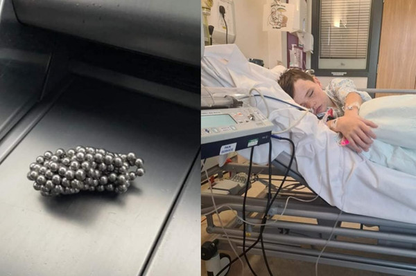 9歲童抖音挑戰吞下磁力珠　劇烈腹痛嘔吐送醫「切30cm腸保命」。（圖／翻攝自Facebook／Borestone Parents）