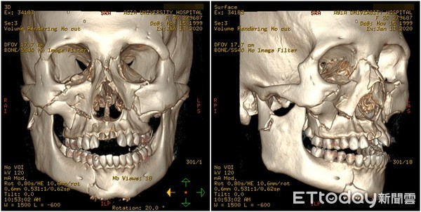 ▲車禍重擊下巴裂眼凹牙斷，女大生毀容靠醫全臉重建獲新生。（圖／院方提供）