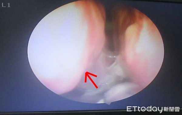▲▼27歲OL鼻夾腫脹，醫師不斷從裏頭抽出膿黃鼻涕，宛如「起司瀑布」。（圖／陳榮峯醫師提供）