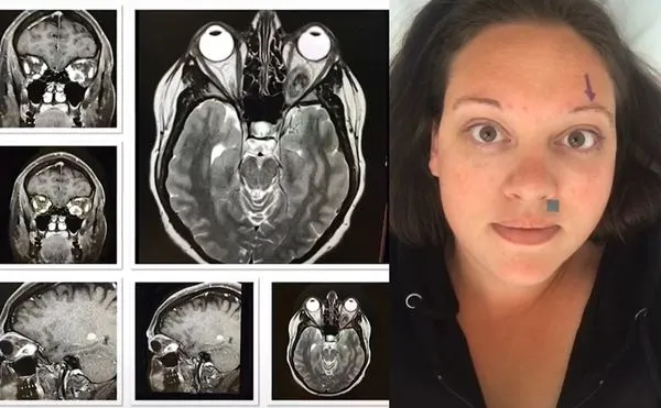 ▲▼失去左眼的考辛思練成了「用眼睛吹熄蠟燭」的獨門絕技。（圖／翻攝自TikTok／eyeofthesarcoma）