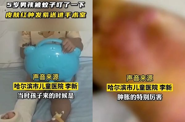 5歲童被蚊子叮長7cm包　切開狂流「40毫升噁臭膿汁」差點終身殘疾。（圖／翻攝自微博／看看新聞KNEWS）