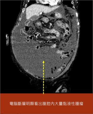 ▲▼宜蘭郭姓婦人罹患百萬分之一罕見腹膜偽黏液瘤。（圖／台北榮總員山分院提供，下同）