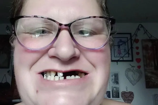 ▲英國一名女子負擔不起高昂的自費拔牙診斷費，於是自己將11顆牙拔除。（圖／翻攝自Twitter／@ziks297）
