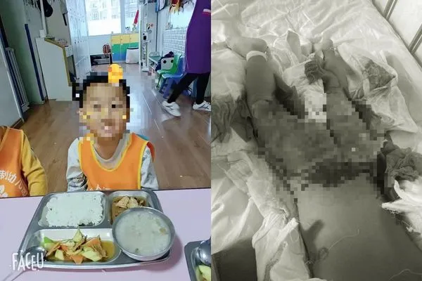 闖進幼稚園廚房　3歲男童跌入「滾燙湯麵鍋」下半身22%嚴重傷燙傷。（圖／翻攝自《騰訊新聞》）