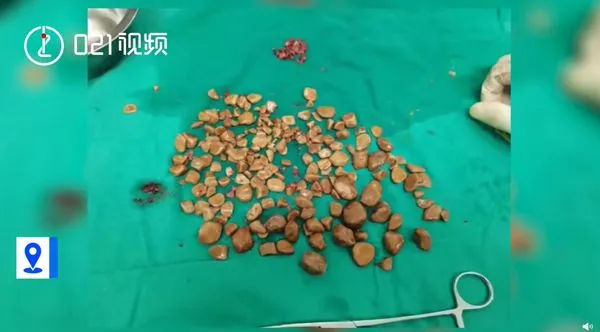 血尿發現膀胱被塞爆！　手術取出「200顆結石」醫震驚：直徑2cm大。（圖／翻攝自微博／021視頻）