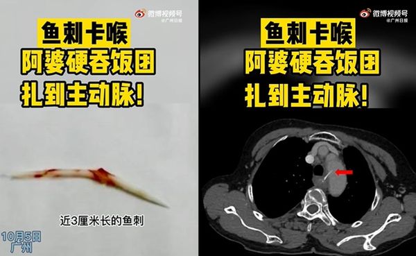 魚刺卡喉「狂吞白飯」反而更痛　女就醫發現刺到大動脈差點喪命。（圖／翻攝自微博／廣州日報）