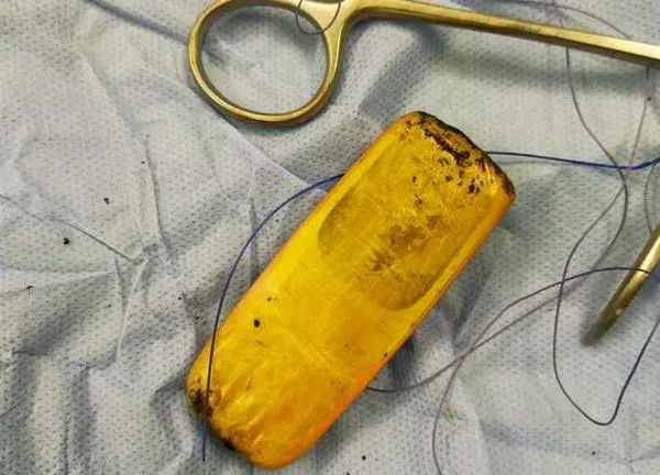 ▲▼醫護動手術取出男子卡在胃部的手機。（圖／翻攝自推特／@khaberni）