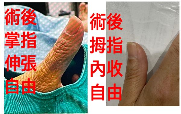 ▲▼經手術後，婦人的拇指伸張自由不卡卡。（圖／李松青醫師提供）
