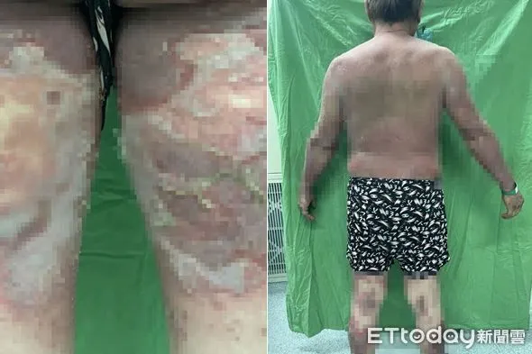 ▲▼澎湖男接種新冠疫苗「全身膿皰脫皮」！8天後皮膚潰爛。（圖／三總澎湖分院提供）