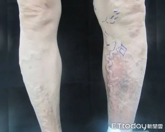 ▲廚師久站有「蚯蚓腿」。（圖／彰化醫院提供）