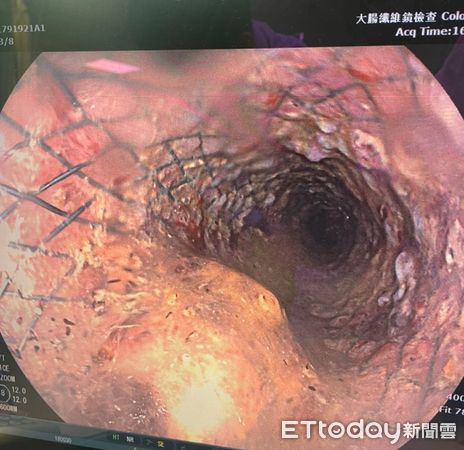 ▲患者裝置大腸支架。（圖／部立南投醫院提供）