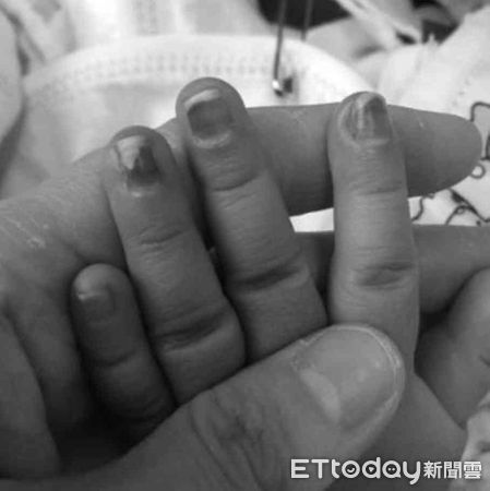 ▲台南傳出保母不慎剪傷1名近2歲女童的食指指尖，因未將剪下的肉塊送醫縫合，造成手指缺損，台南市社會局目前已受調查中。（圖／示意圖，非當事人，記者林悅翻攝）