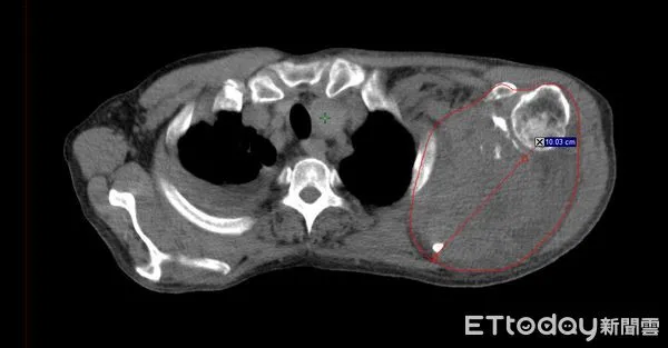 ▲圖右紅圈處為患者左側肩胛骨直徑約10公分的巨大腫瘤。（圖／部立南投醫院提供）