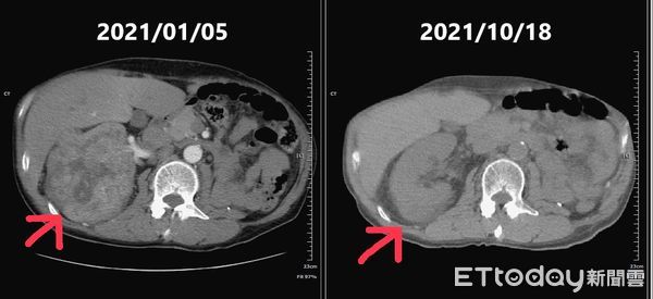 ▲圖左為腎臟腫瘤，圖右可看到腫瘤幾乎消失。（圖／部立南投醫院提供）