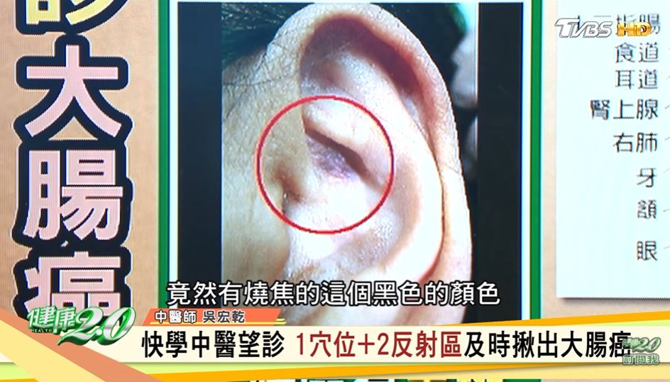 大腸癌「從耳朵和臉」能看出！醫嘆：他冒燒焦色已第三期。（圖／截自《健康2.0》YouTube）