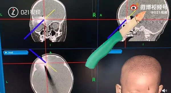 水果刀從左眼插大腦！1歲女童就醫回家發現　「4cm斷刀」仍在腦內。（圖／翻攝自微博／021視頻）