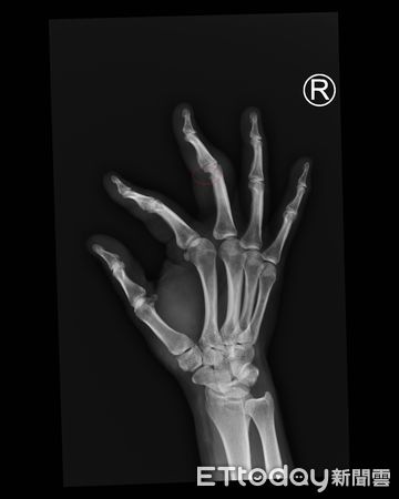 ▲▼圖為林女右手X片，中指關節被指指關節，手指缺了一小塊，圖為左掌張圖。（圖／部立彰）