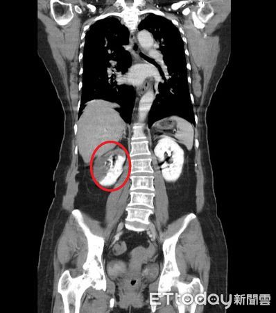 ▲陳婦的右腎因血栓阻塞血管（紅圈處），造成腎中風發生。（圖／記者黃孟珍翻攝）