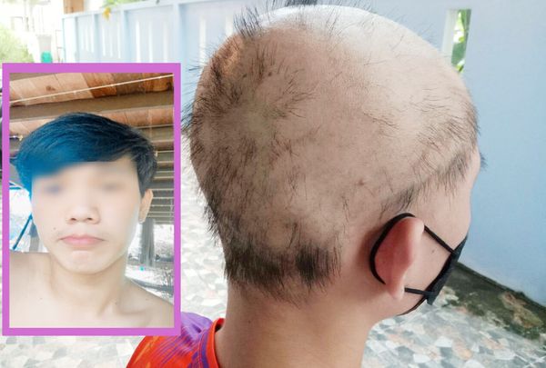 ▲▼泰國19歲少年打完2劑科興「頭髮掉光」全禿。（圖／翻攝自Dailynews）