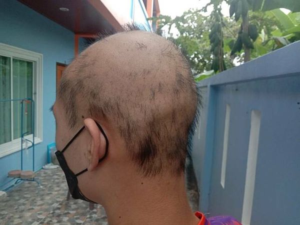 ▲▼泰國19歲少年打完2劑科興「頭髮掉光」全禿。（圖／翻攝自Dailynews）