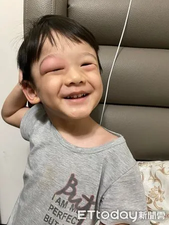 ▲3歲弟「變鹹蛋超人」被狂盯！媽喊冤：不是家暴　醫急叮囑4點。（圖／郭小姐授權引用）