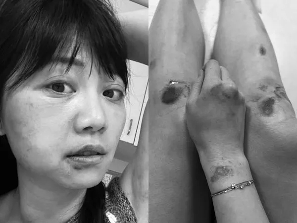 ▲▼高嘉瑜遭男友毆打傷勢。（圖／高嘉瑜提供）