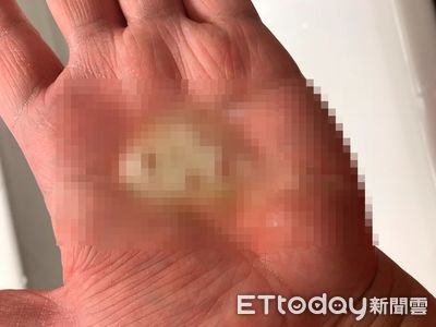 從「痰的顏色」看出哪裡病了!醫警告:伴隨4現象恐傷心肺