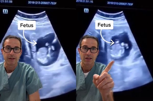 女出血14天「肝臟中發現胎兒」　醫分享奇異片網嚇壞：怎麼進去的。（圖／翻攝自TikTok／nicu_musings）