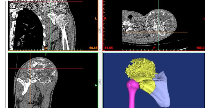 ▲▼ 左肩膀長足球大腫瘤。（圖／翻攝自秒拍）
