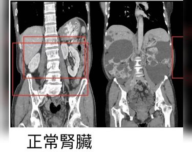 中壯男腹部痛急送醫　超音波一照內臟竟塞滿水泡