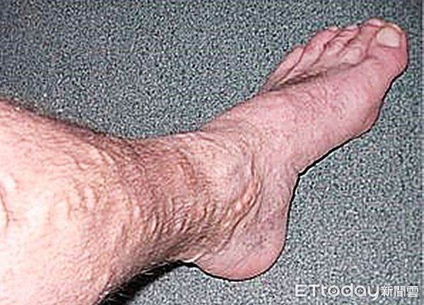 ▲中老年患者若雙腿浮出暗綠色血管，面對靜脈曲張最好及早接受專科醫師診斷治療。（圖／記者沈繼昌翻攝）