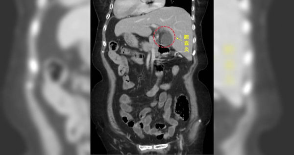 正常人的左上腹是胃或大腸，但阿嬤卻是膽囊，醫師透過電腦斷層檢查才發現。（圖／中醫大新竹附設醫院提供）